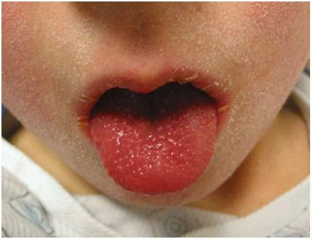 Oral finding in a febrile child