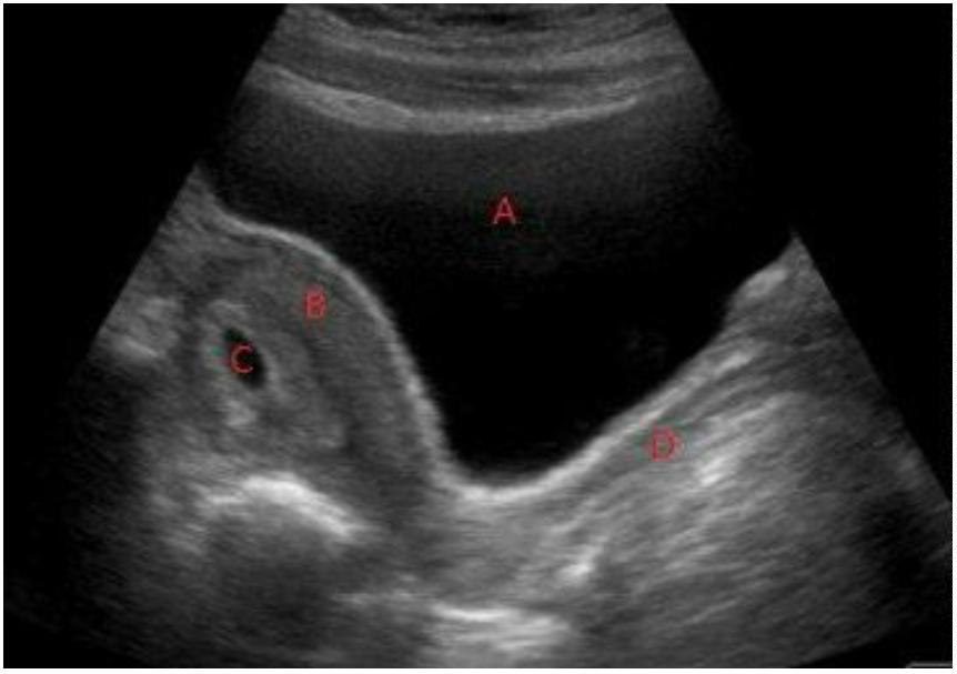 Labelled pelvic ultrasound for early pregnancy bleeding