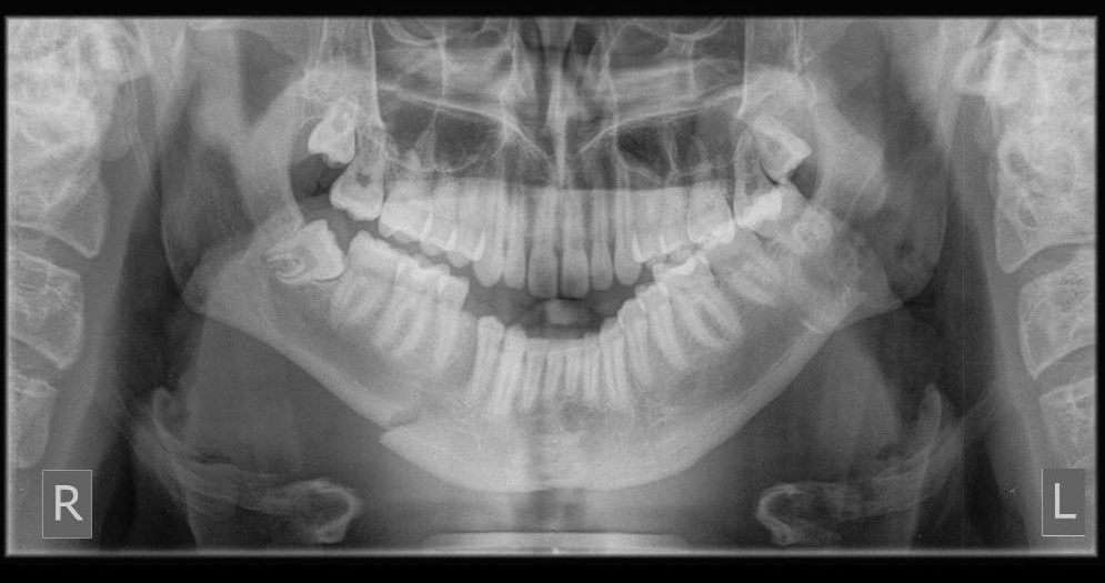 OPG after jaw trauma