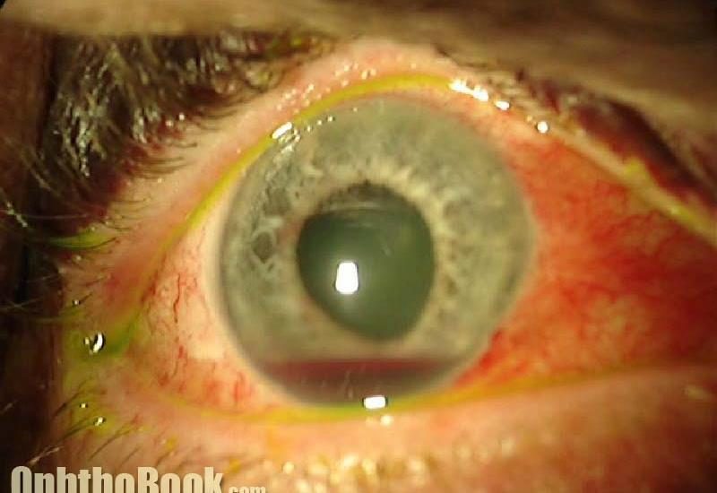 Eye photograph after blunt trauma