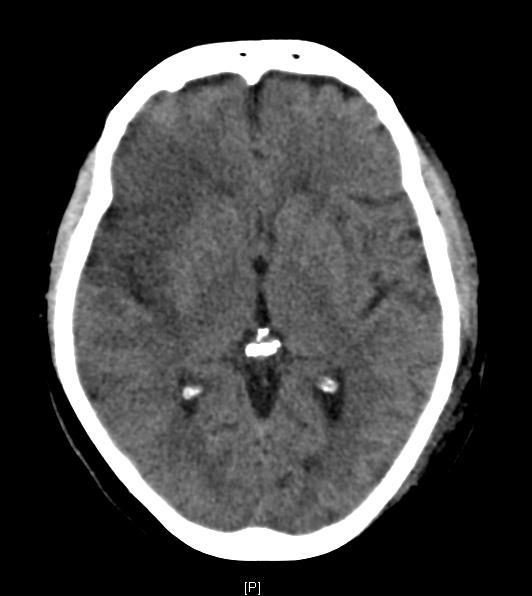 Axial CT brain image