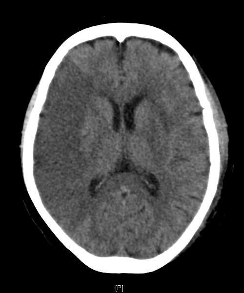 Axial CT brain image