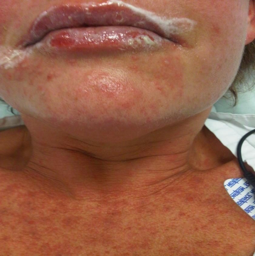 Facial and mucosal rash image
