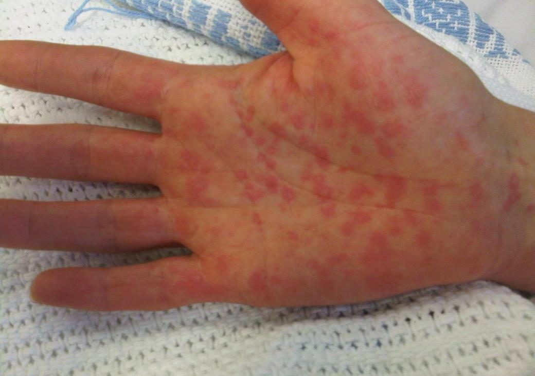 Palmar rash image