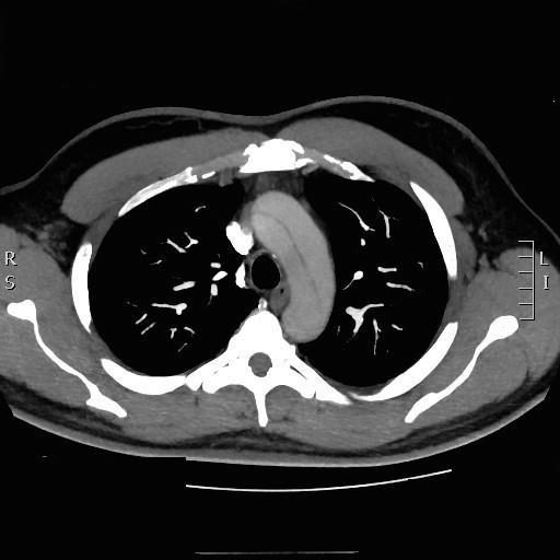 CTPA image