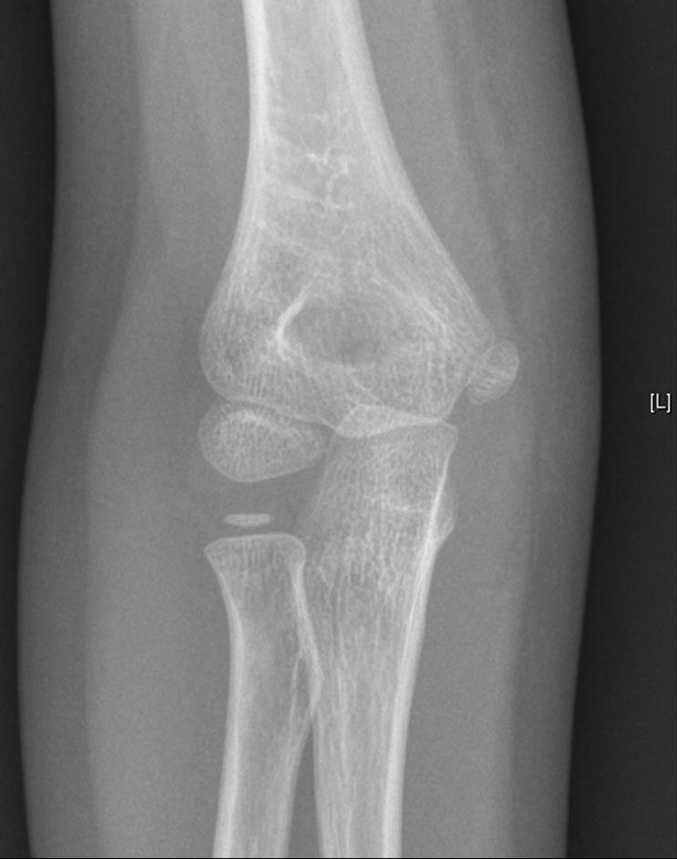 AP elbow X-ray
