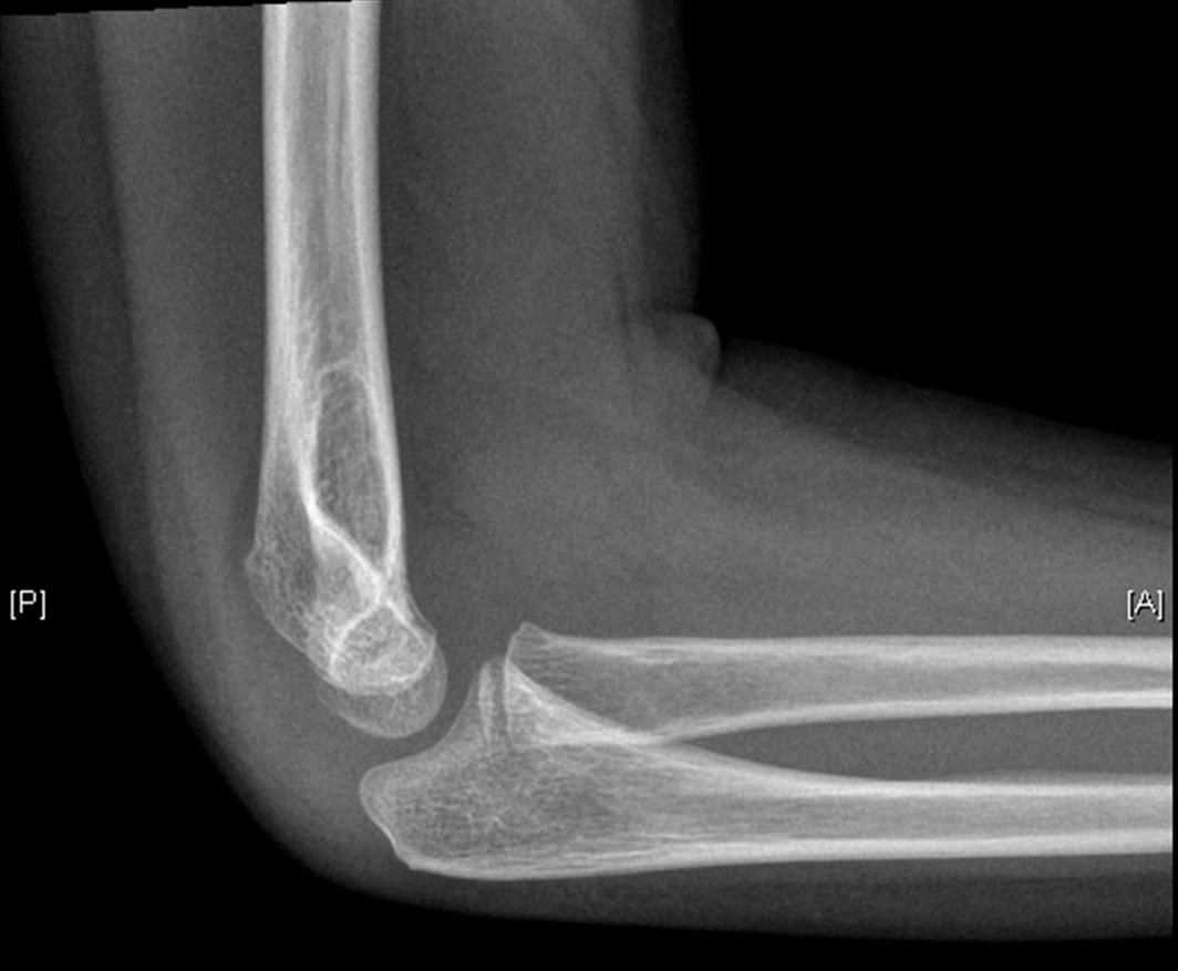 Lateral elbow X-ray