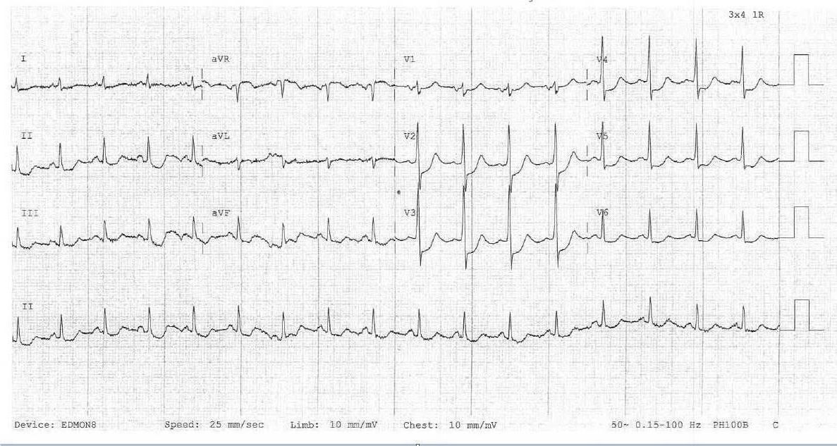 ECG from rural ED chest pain presentation