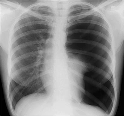 Chest X-ray after diving-related collapse