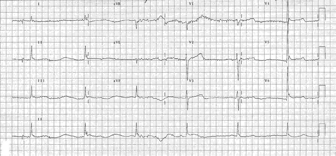 ECG from low core temperature presentation