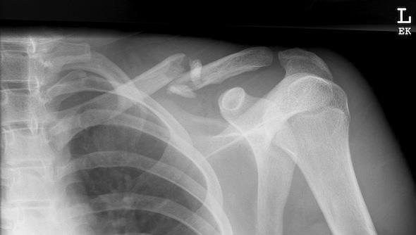 Left clavicle X-ray