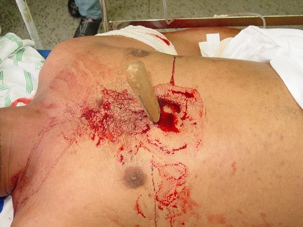 Penetrating left chest injury with knife in situ