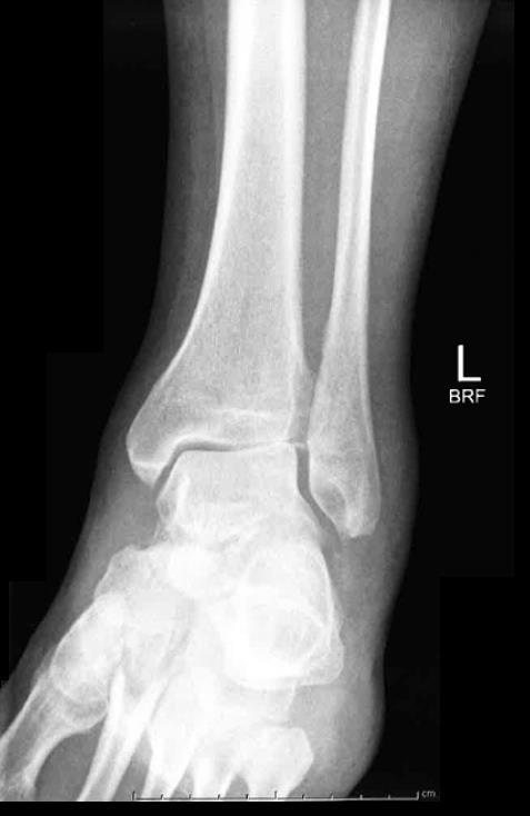 AP ankle X-ray