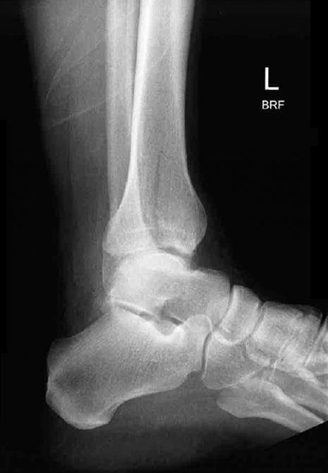 Lateral ankle X-ray