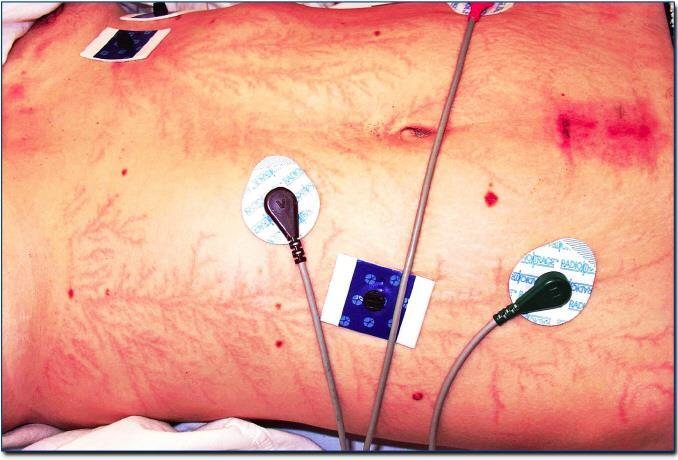 Clinical photo after collapse on a golf course
