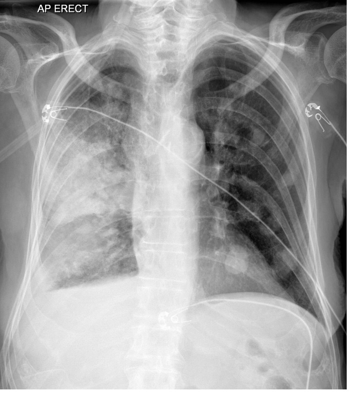 Chest X-ray in febrile dyspnoea presentation