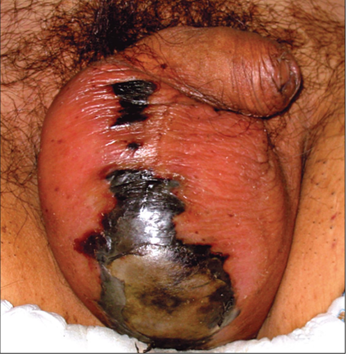 Clinical photo of perineal presentation