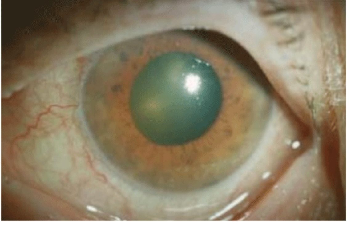 Clinical photo of painful red eye