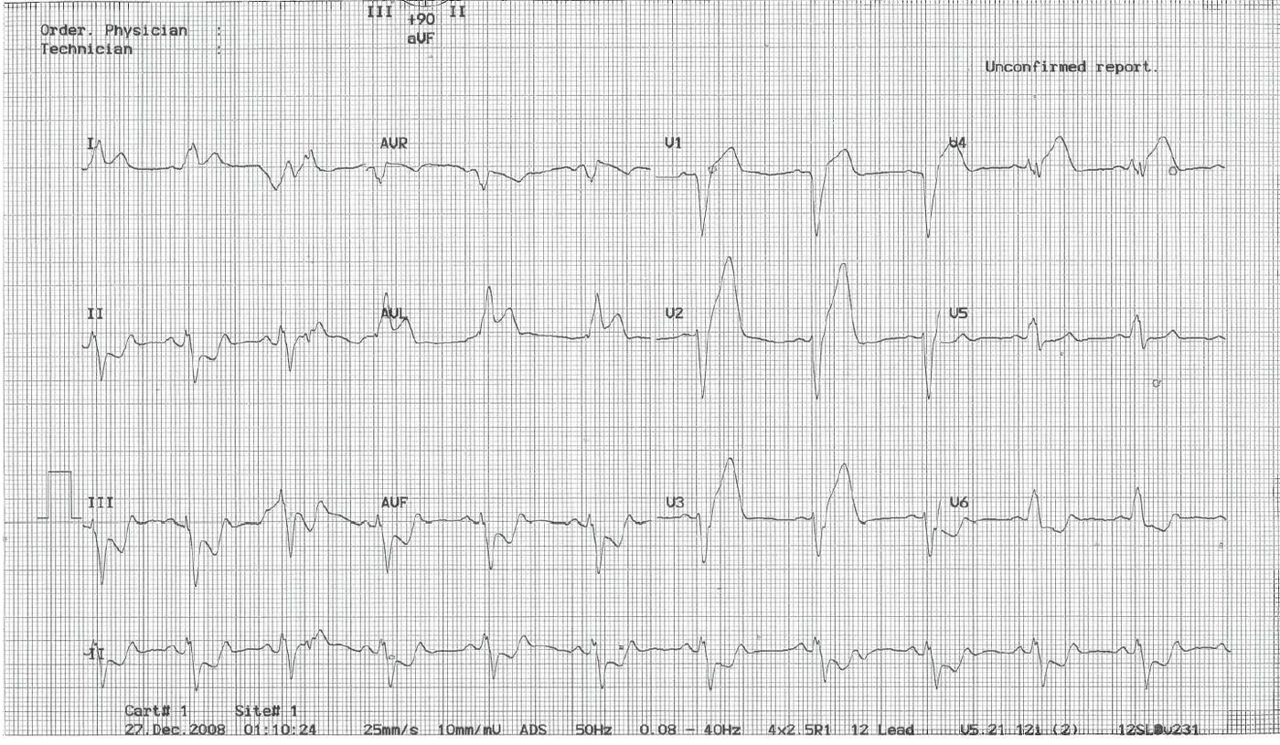 ECG in chest pain presentation