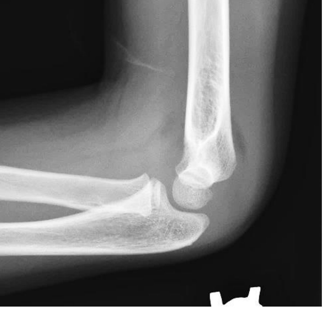 Lateral elbow X-ray