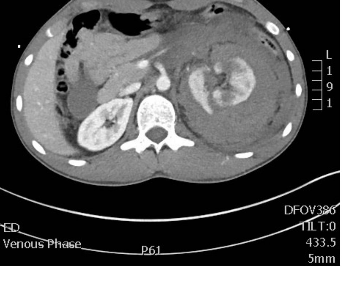 Axial contrast CT abdomen image