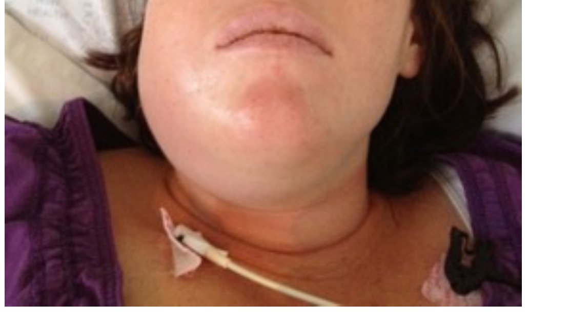 Clinical photo of jaw and neck presentation