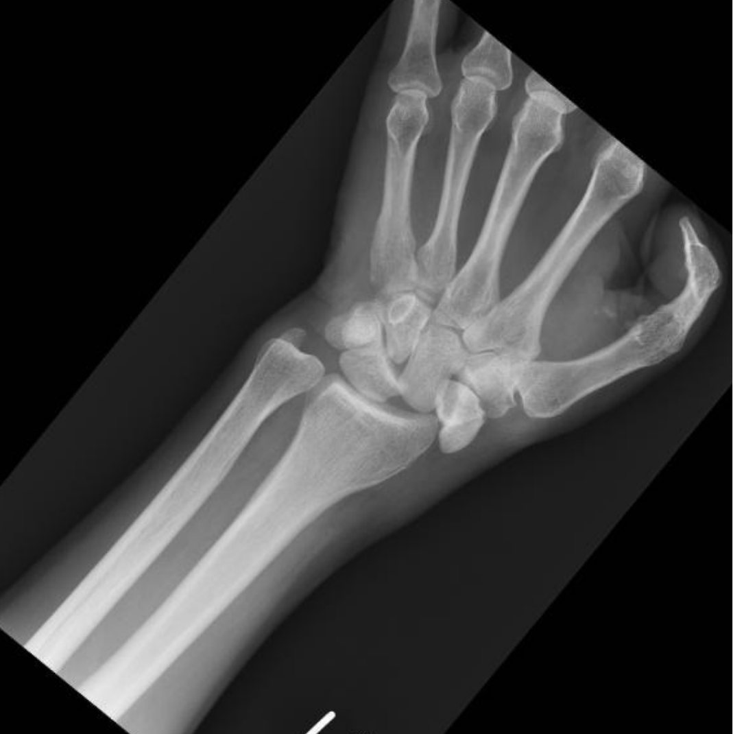 Wrist X-ray, AP view