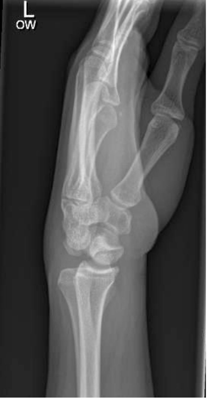 Wrist X-ray, lateral view