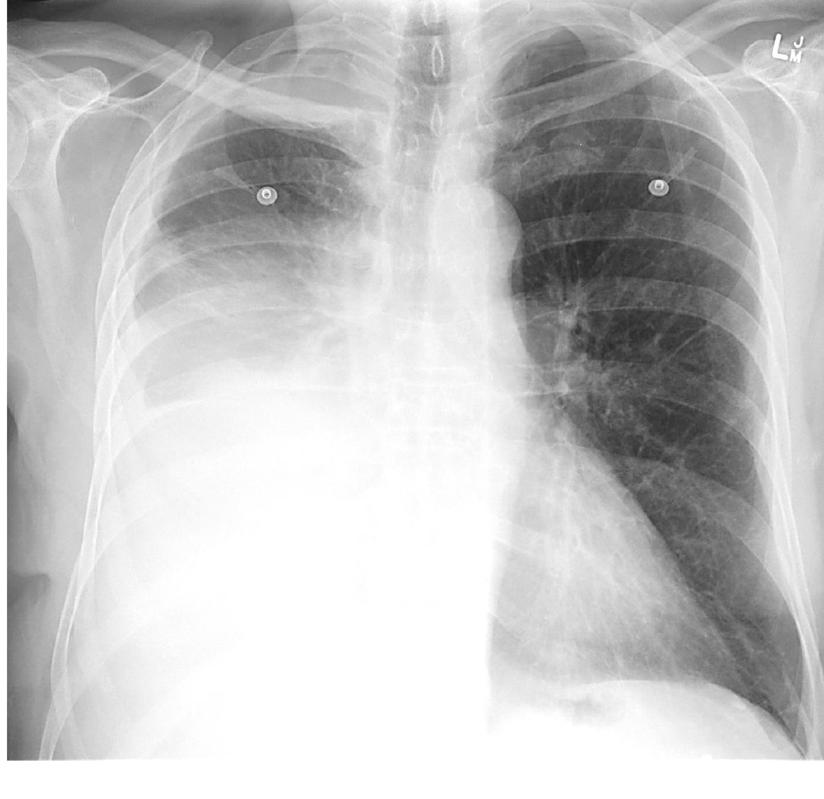 Chest X-ray for respiratory presentation