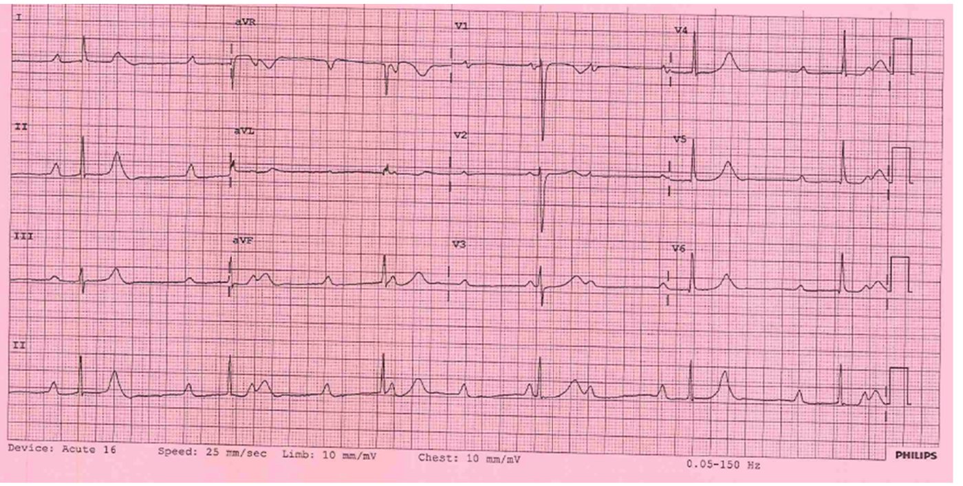 ECG in syncope presentation
