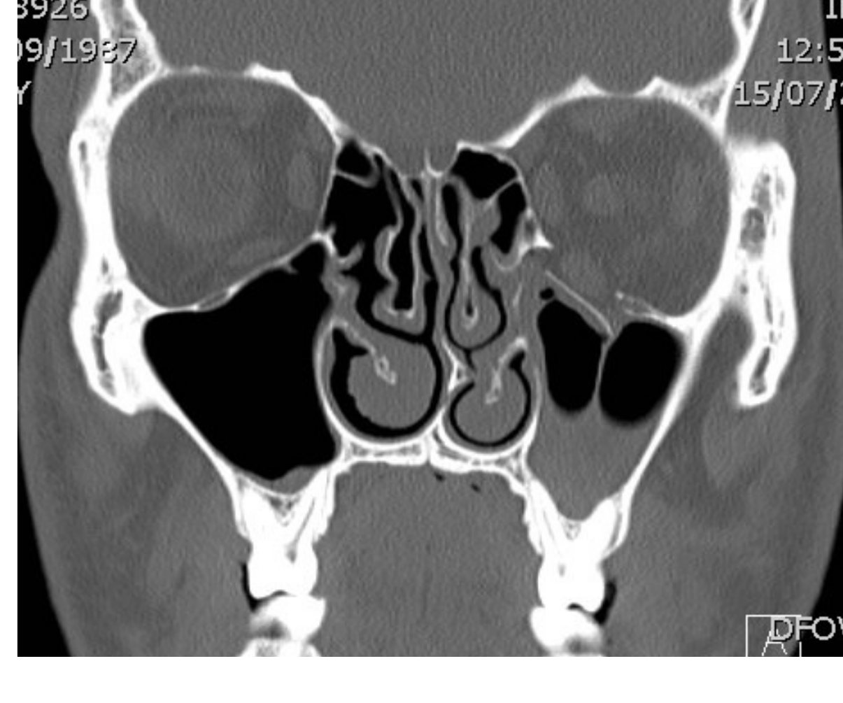 Coronal CT image of facial trauma