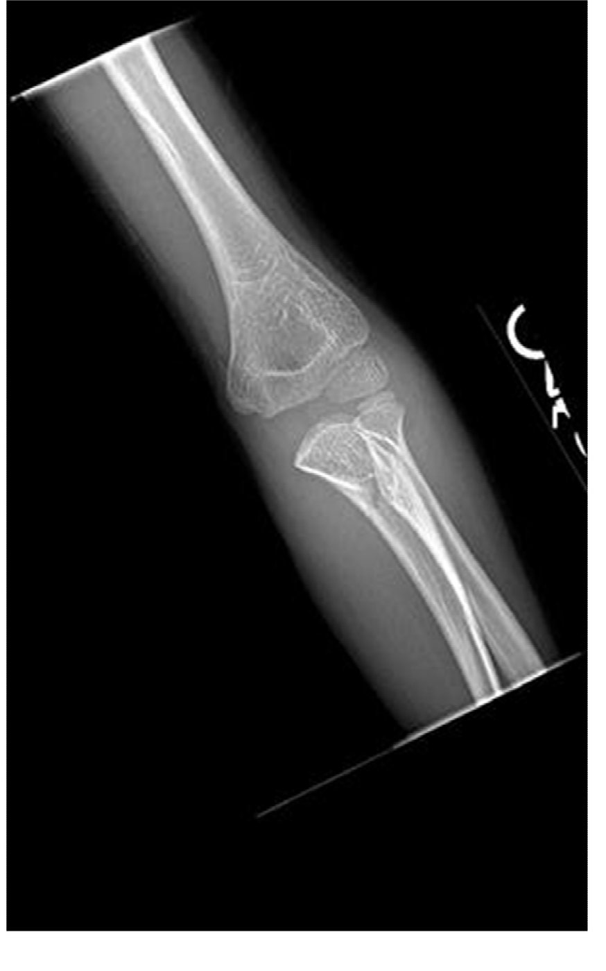 AP elbow X-ray