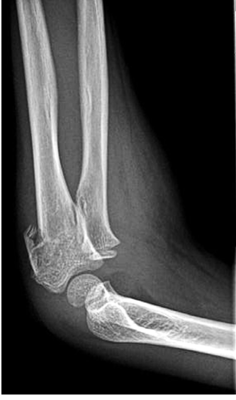 Lateral elbow X-ray