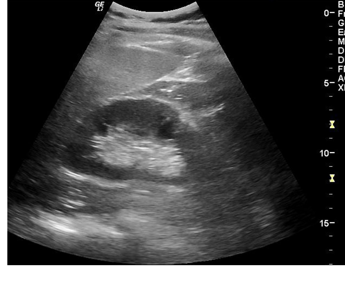 FAST right upper quadrant image