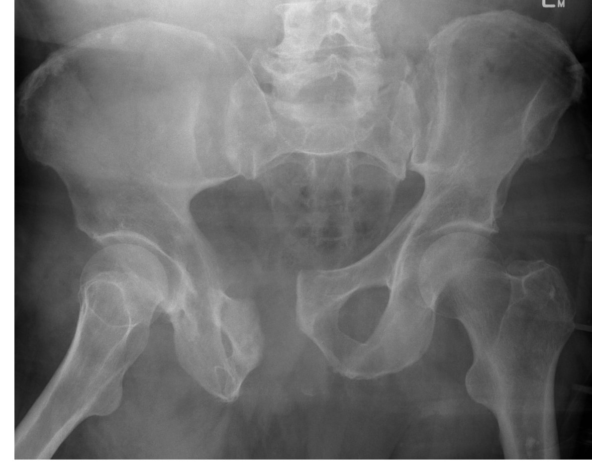 Pelvic X-ray after tractor injury