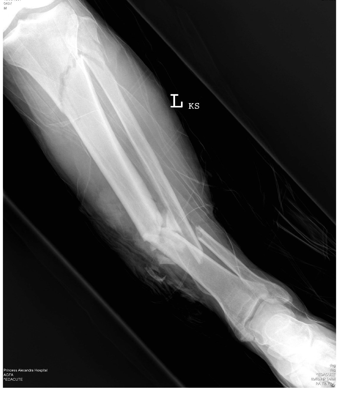 Lower-leg X-ray