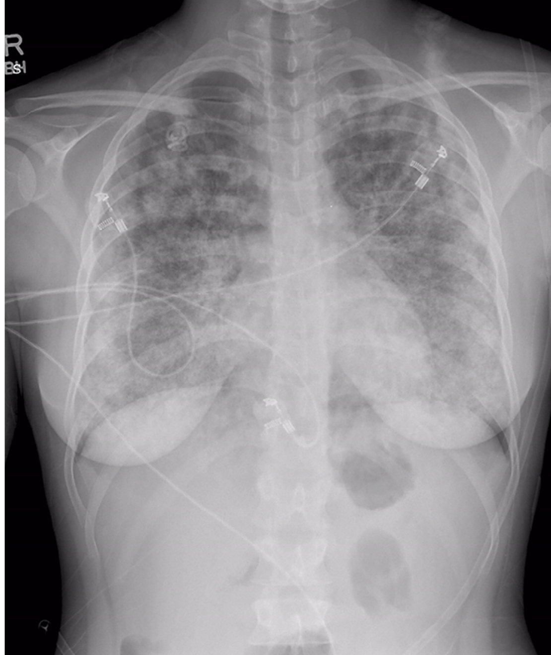 Chest X-ray for dyspnoea during chemotherapy