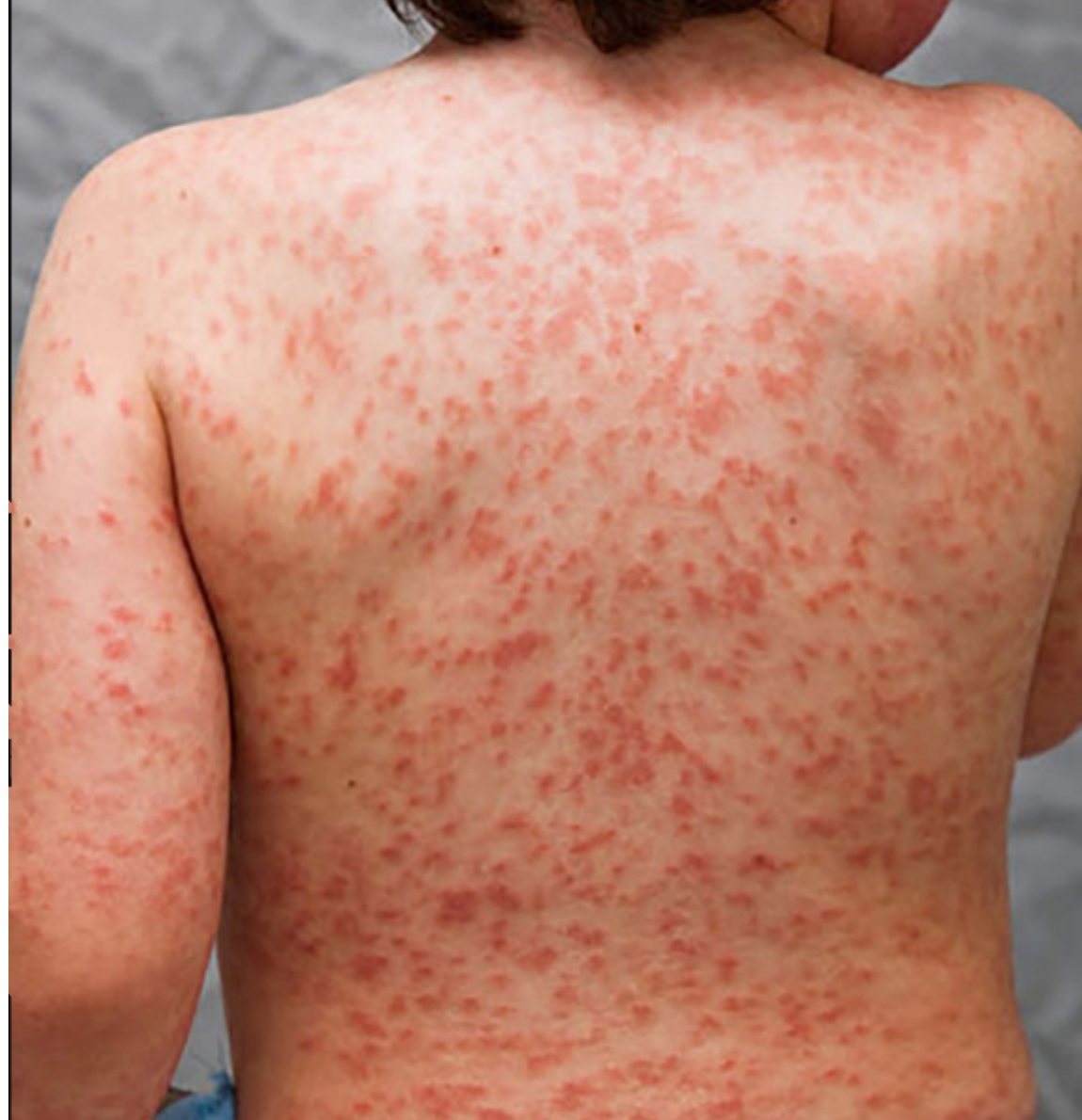 Clinical photograph cropped to the back and shoulders showing a widespread erythematous rash