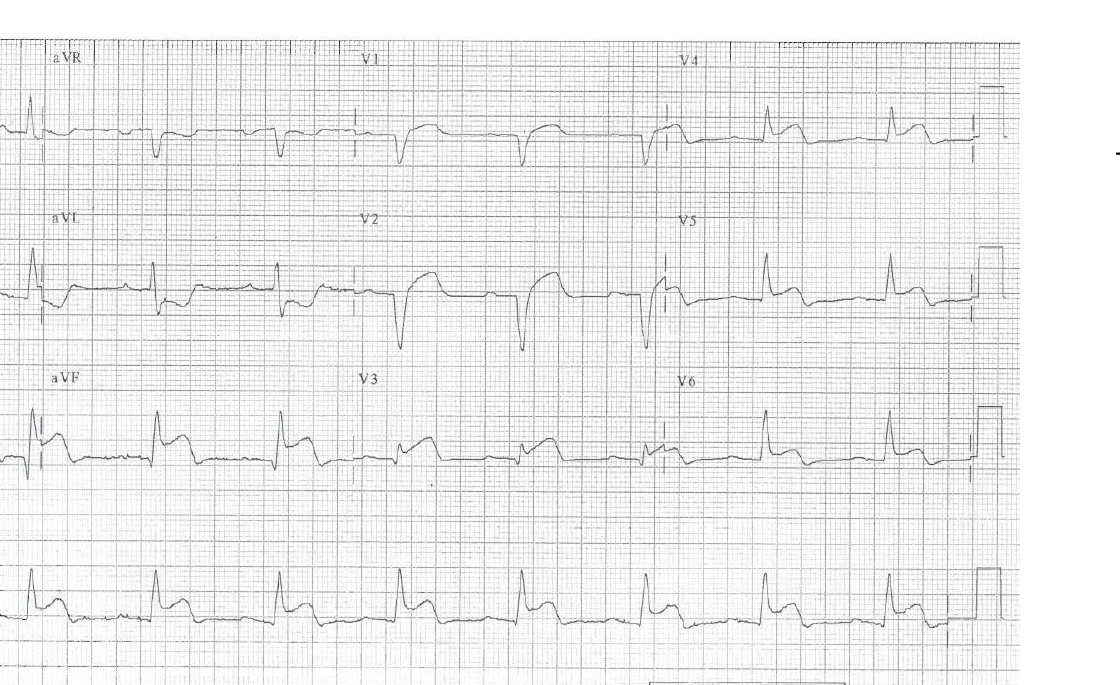 ECG for a young adult with severe chest pain after a viral prodrome.