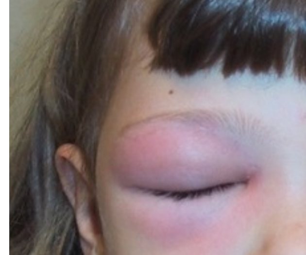 Cropped clinical photograph showing unilateral periorbital swelling.