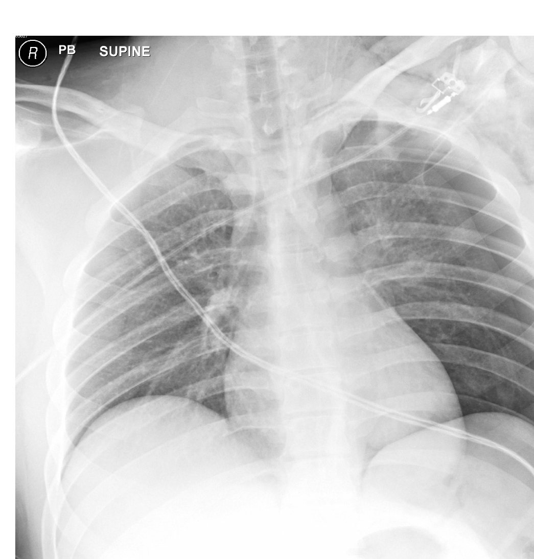 Supine chest X-ray after penetrating chest trauma.