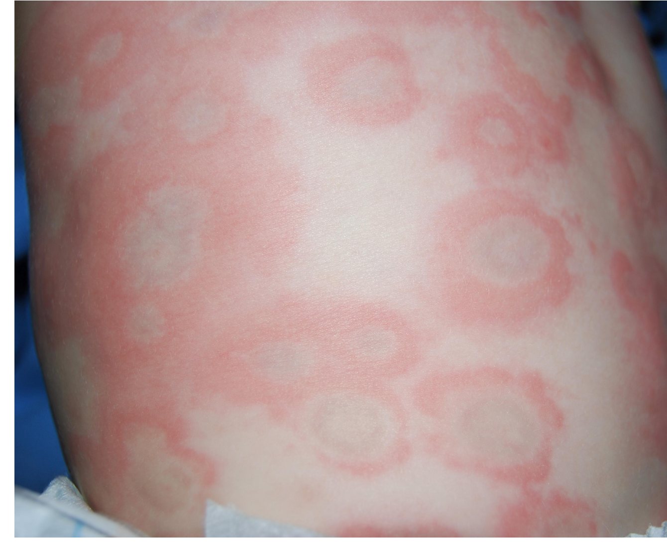 Clinical photograph of a paediatric torso rash.