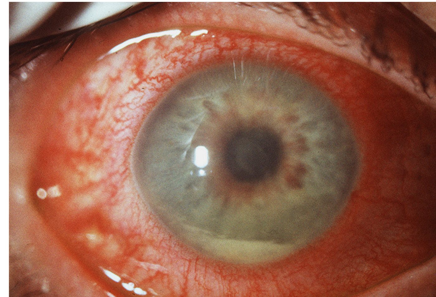 Clinical photograph of a painful red eye.