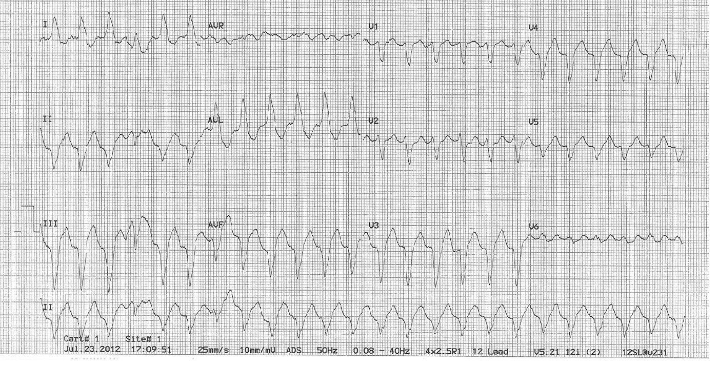 ECG for the chest pain and dizziness presentation.