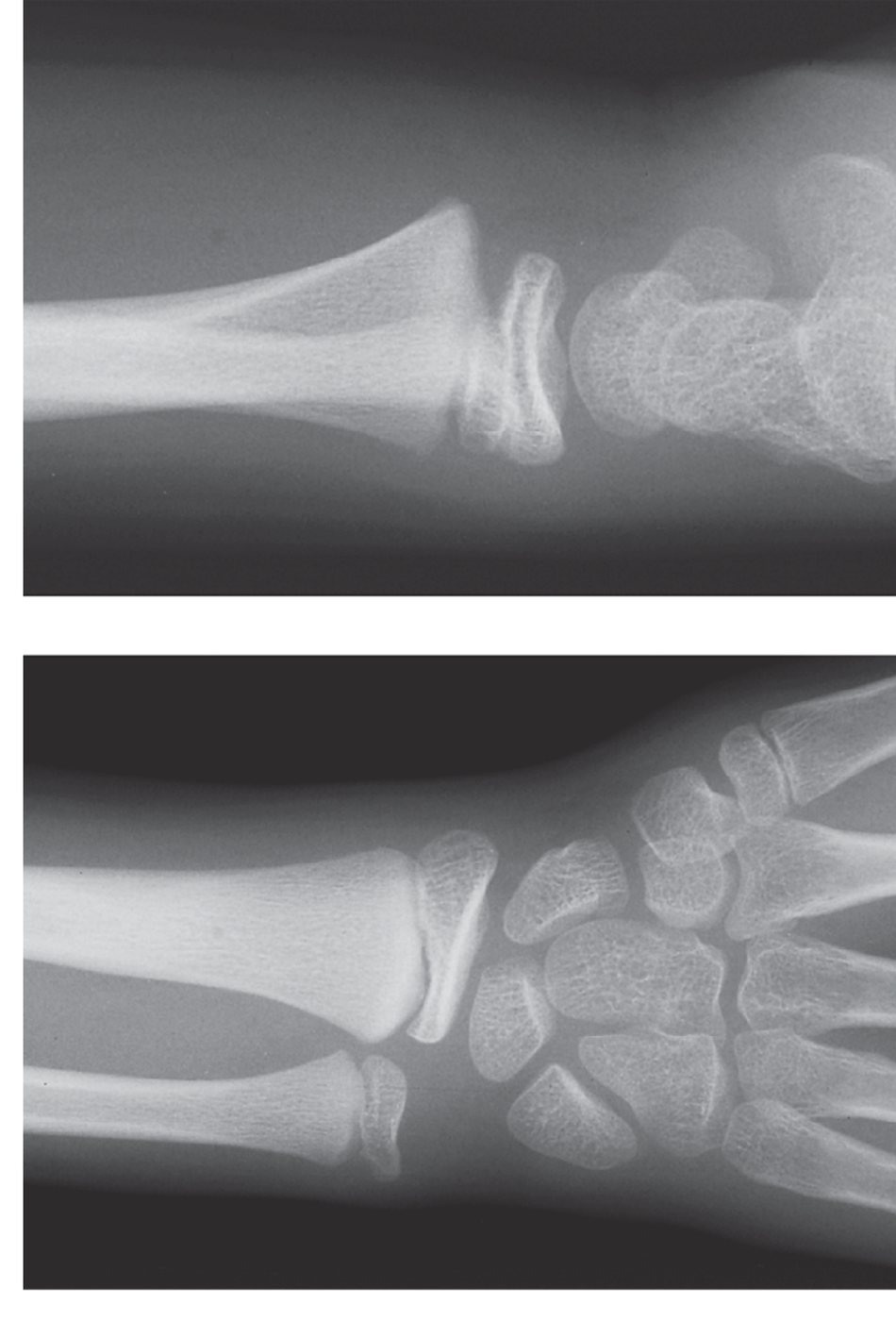 Wrist X-rays after playground fall.