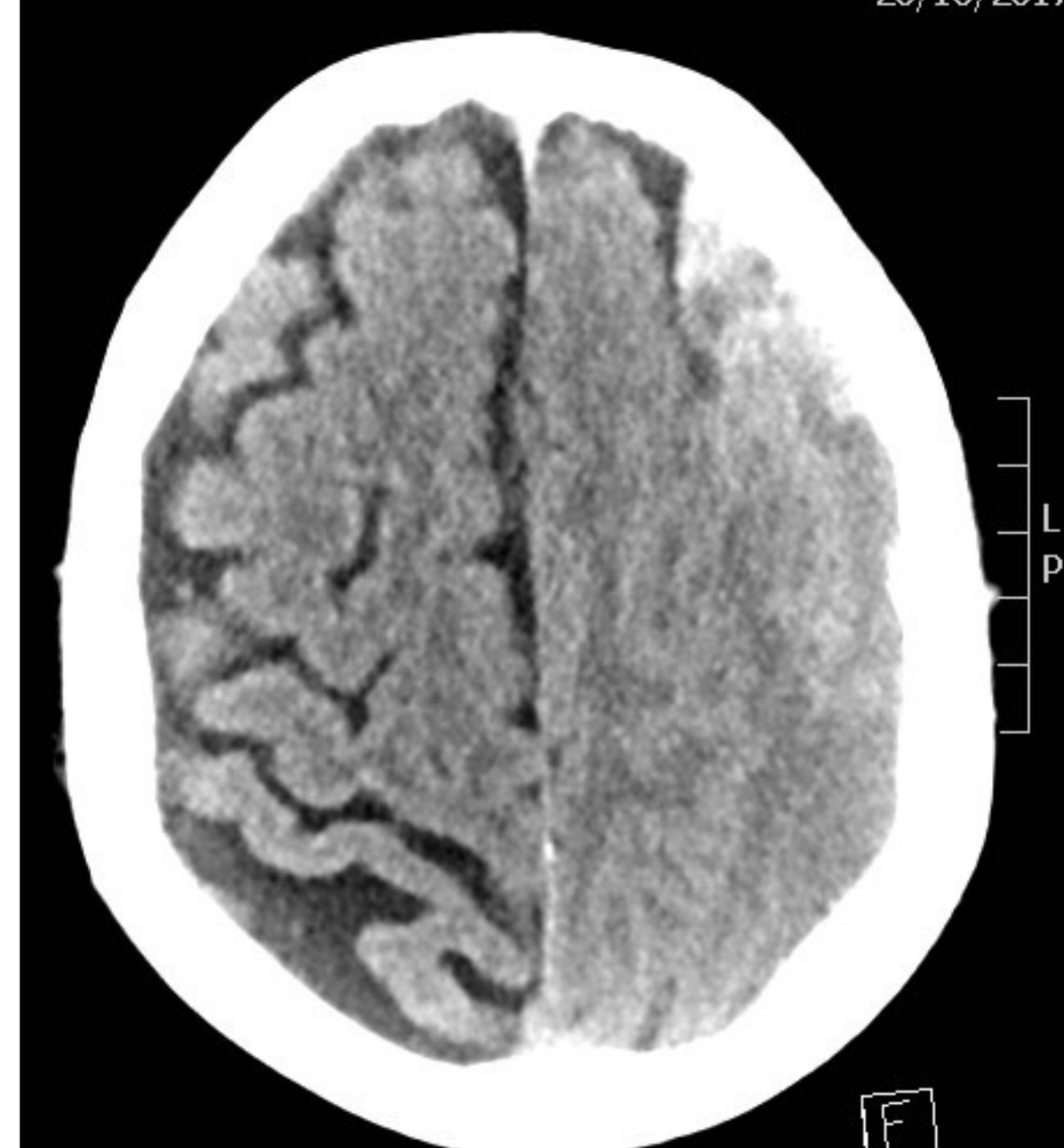 CT brain image after head injury from a fall.
