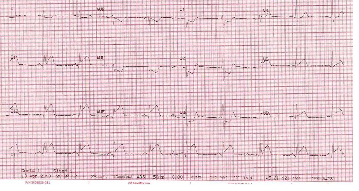 Arrival ECG after thrombolysis for myocardial infarction.