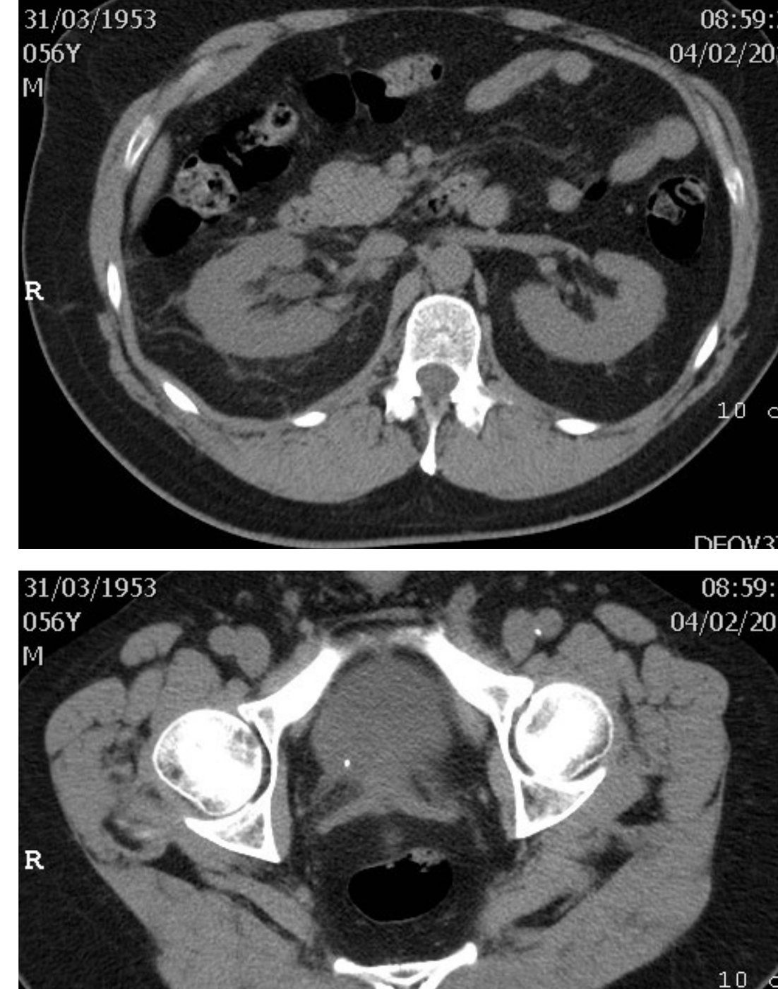 Two non-contiguous CT abdomen pelvis slices for severe flank pain.