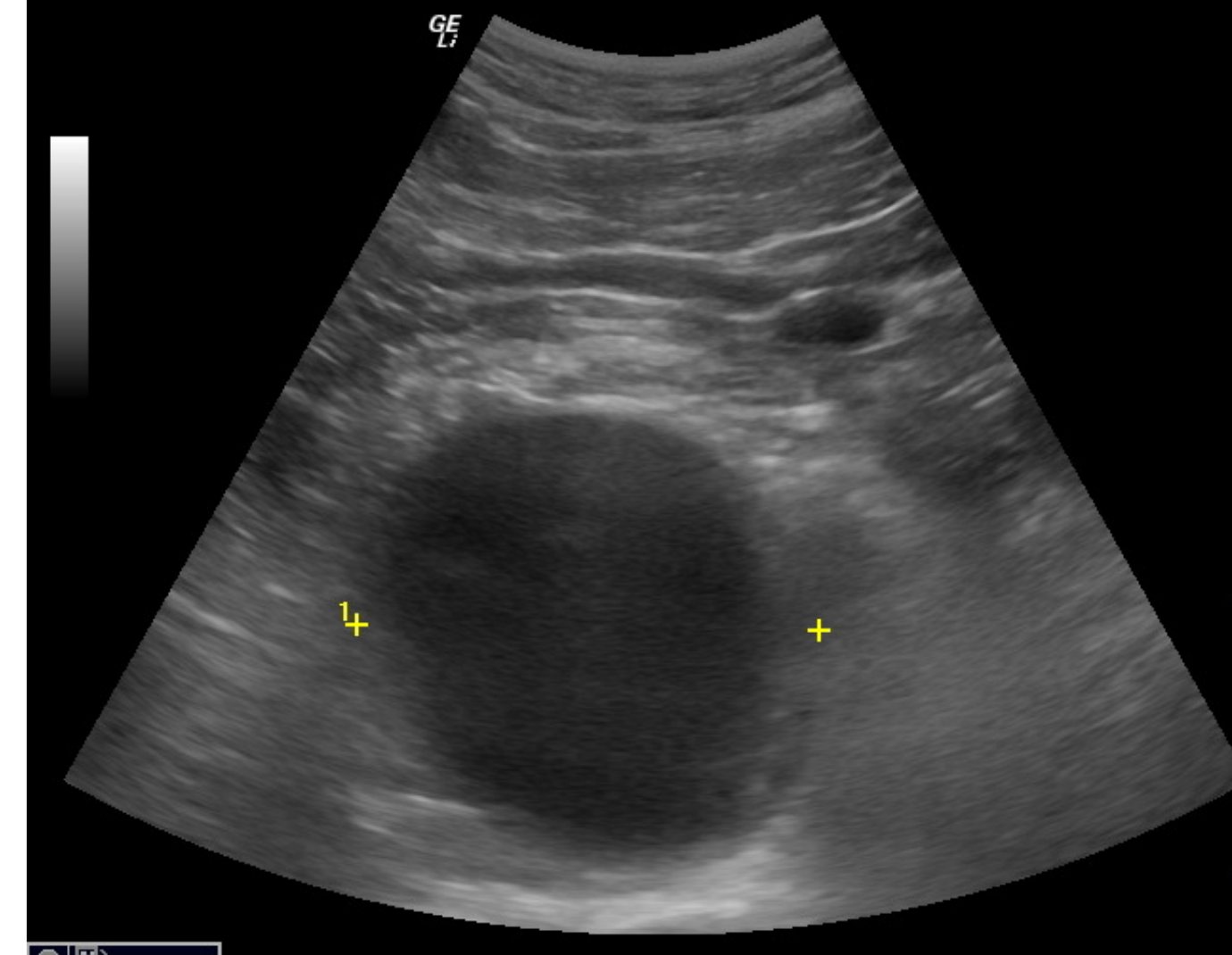 Bedside abdominal ultrasound image.