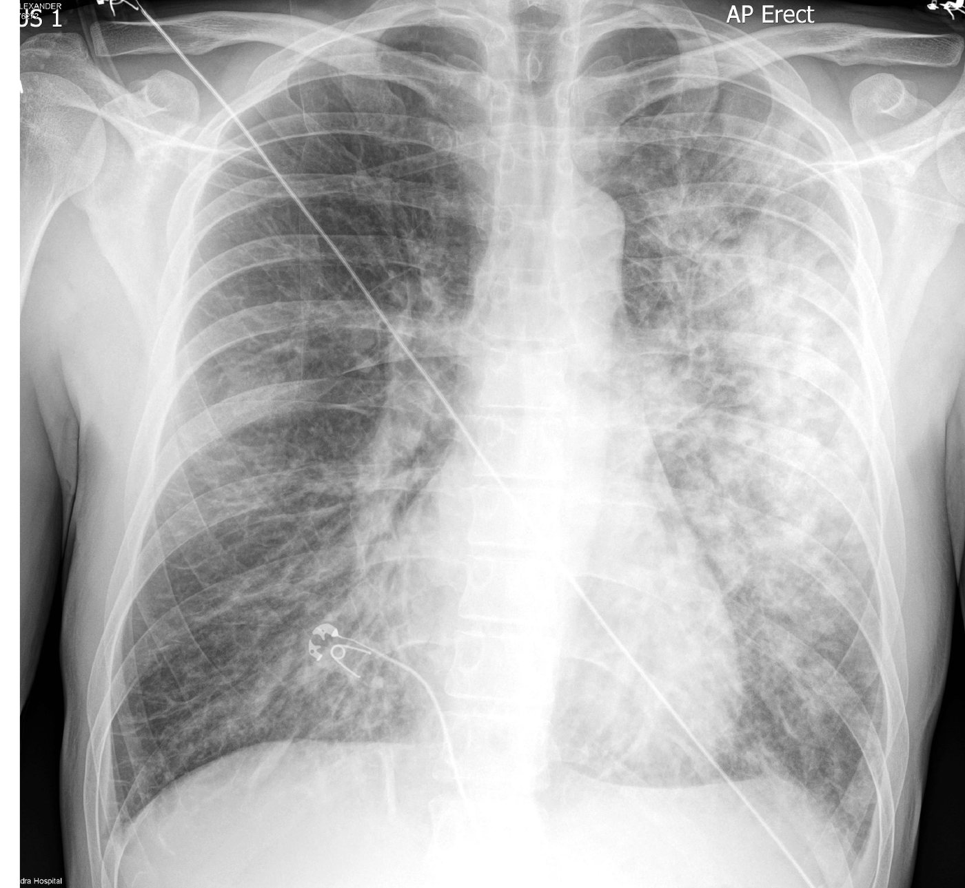 Chest X-ray for progressive breathlessness.